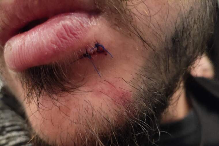Imatge de Jonathan desprÃ©s de l'agressiÃ³