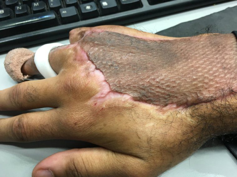 AsÃ­ quedÃ³ la mano de Antoine tras la cirugÃ­a